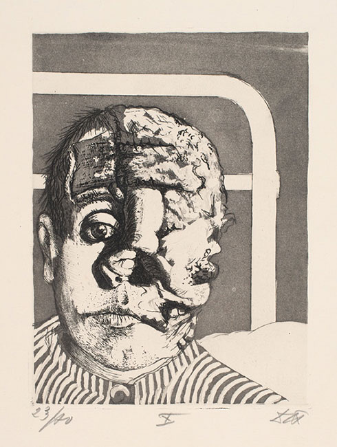 Artwork: Transplantation SkinGraft